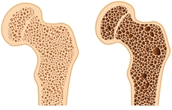 osteoporosi kai antimetopisi